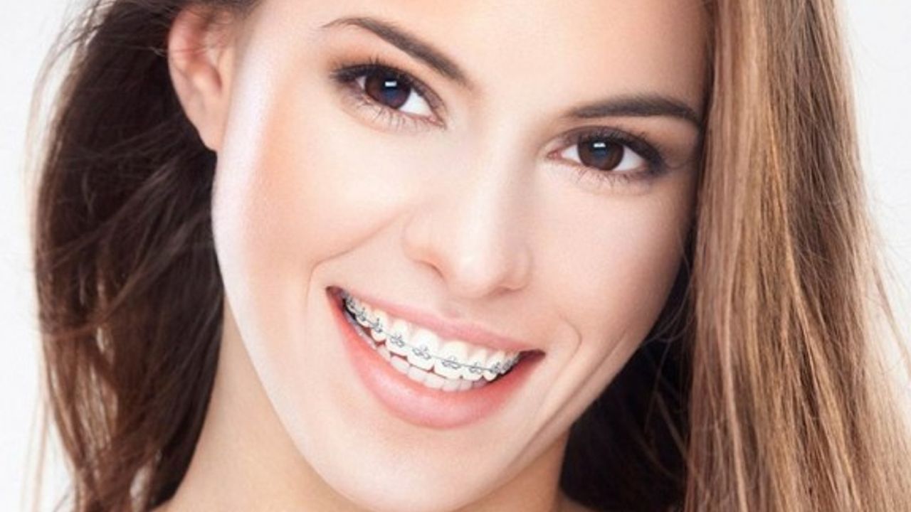 Diş teli tedavisinde doğru bilinen 5 yanlış