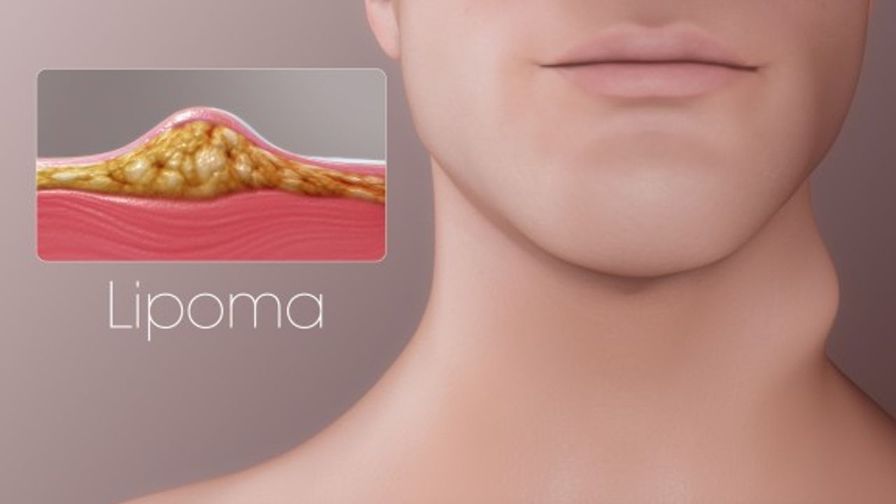 Yağ bezesi nedenleri, belirtileri ve tedavisi