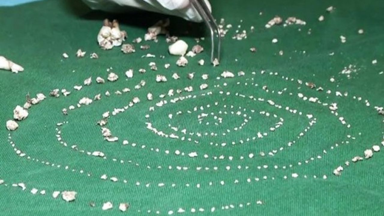 Hintli çocuğun ağzından 526 diş çıkarıldı