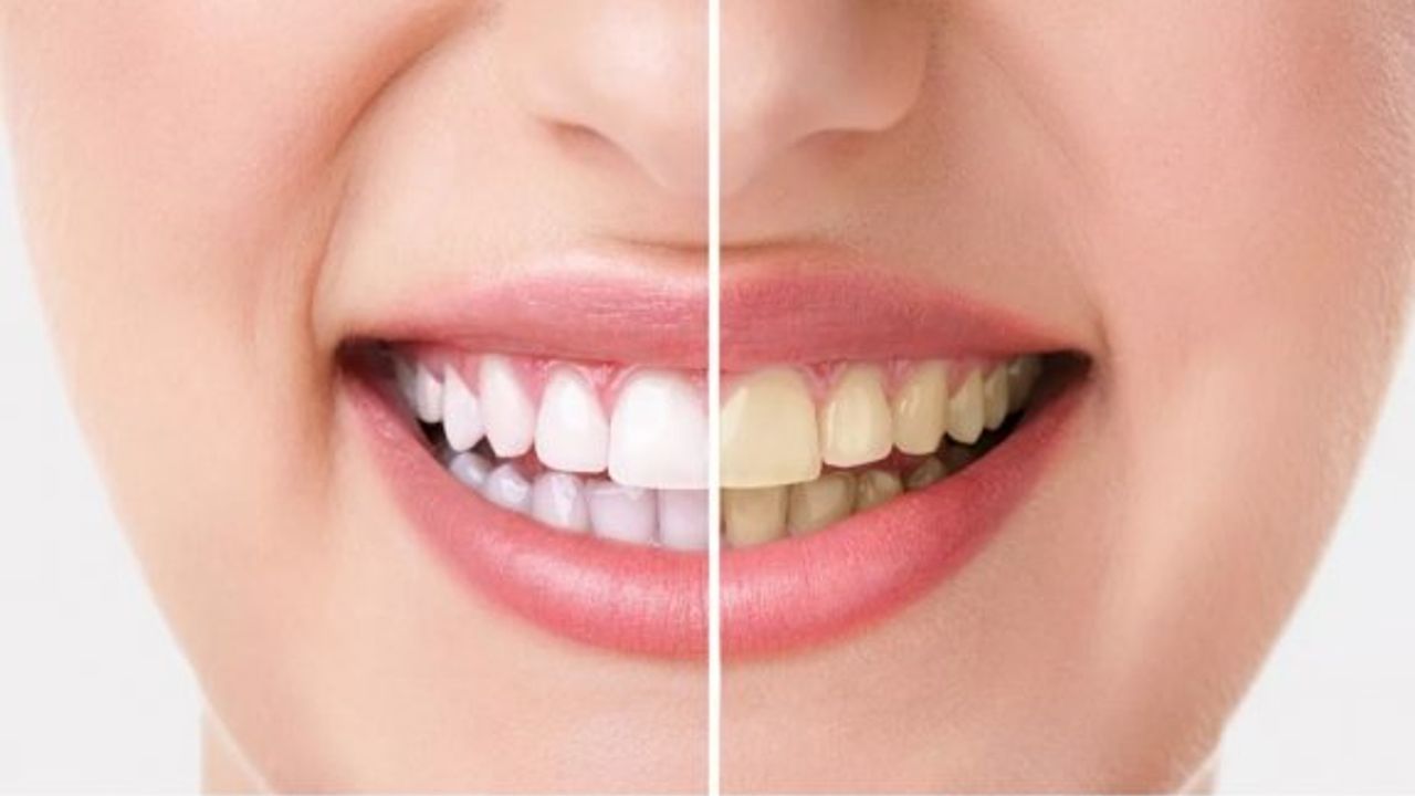 Diş beyazlaştırma yöntemi “ağartma”, mutlaka doktor kontrolünde uygulanmalı