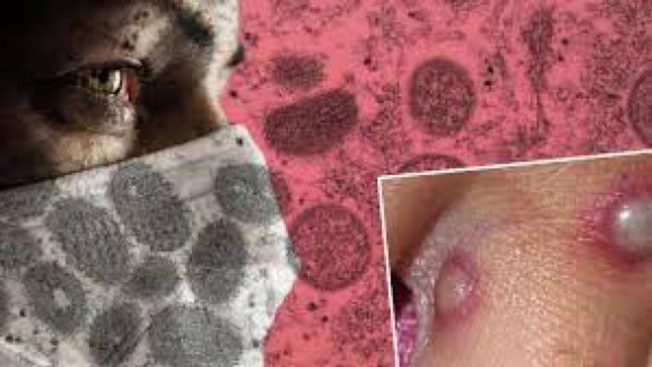 Maymun çiçeği virüsü 16 ülkeye sıçradı