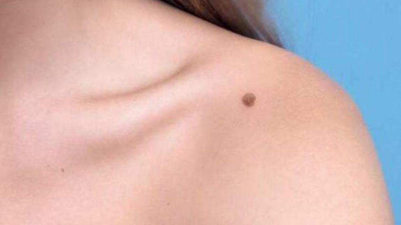 Vücutta Çıkan Her Ben Tehlikeli Mi?