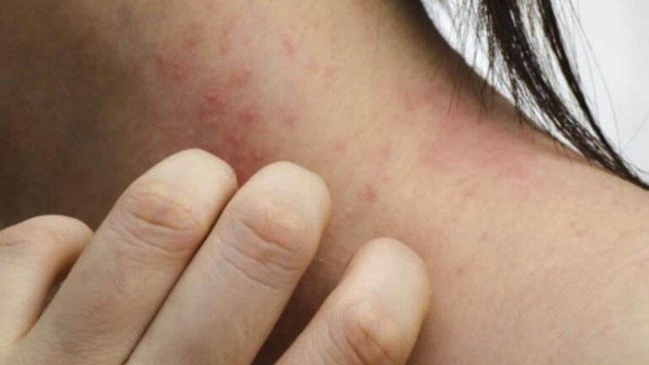 Güney'de 6 ayda 6 endemik tifüs vakası