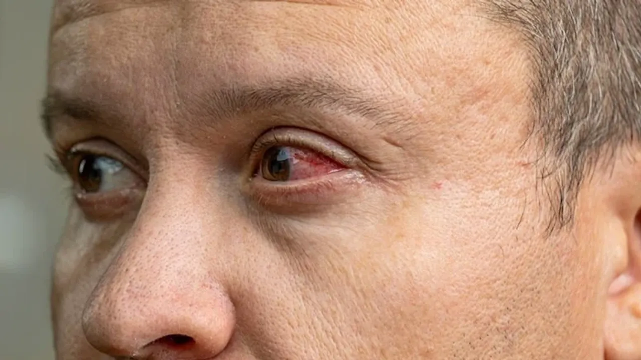 Gözleri kanatan virüs tespit edildi: Salgın korkusu başladı