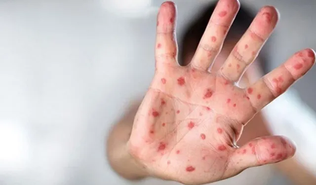 Yeni salgın dünyaya yayılıyor